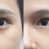 Đánh bay bọng mắt, nếp nhăn với phương pháp Shiatsu